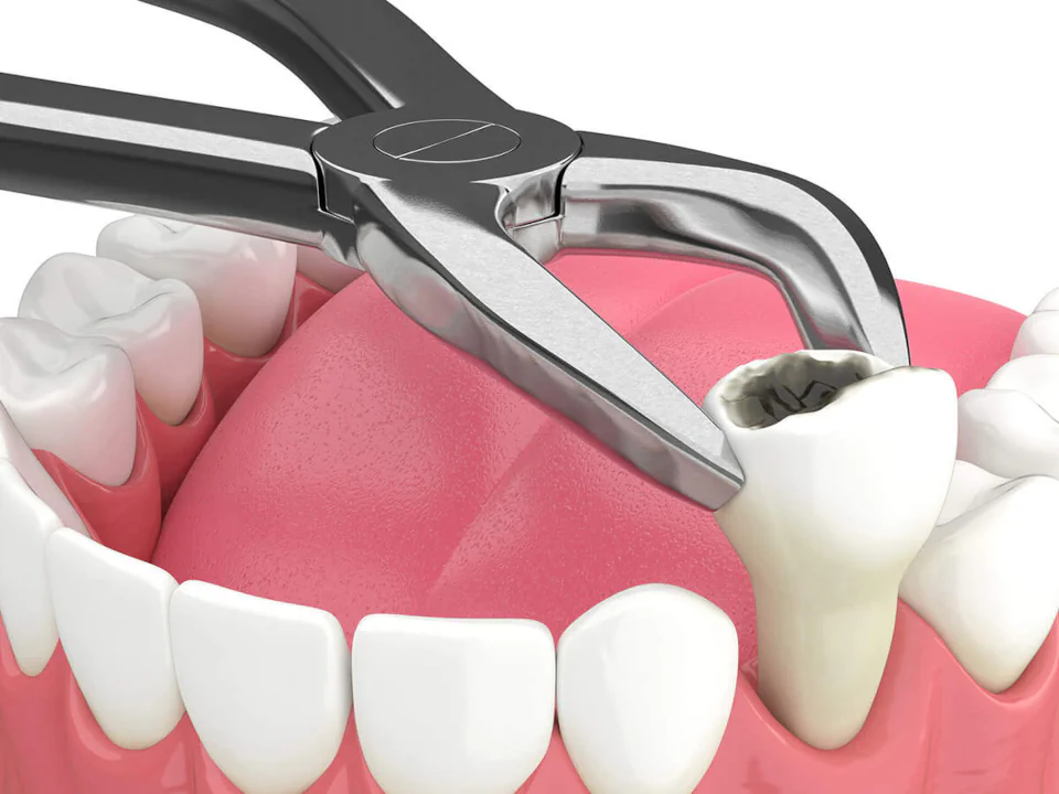 Tooth extractions in Bowling Green, KY at Precision Dental.
