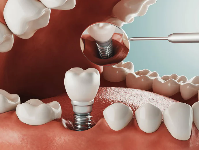 Dental implants in Bowling Green, KY at Precision Dental.