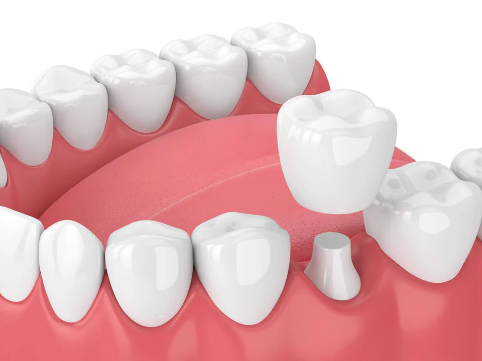 Dental crowns and dental bridges in Bowling Green, KY at Precision Dental.