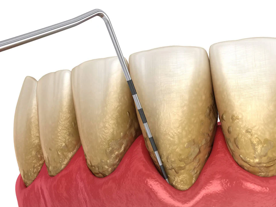 Gum disease treatment in Bowling Green, KY at Precision Dental.