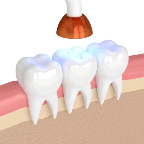 Dental fillings and dental sealants in Bowling Green, KY at Precision Dental.