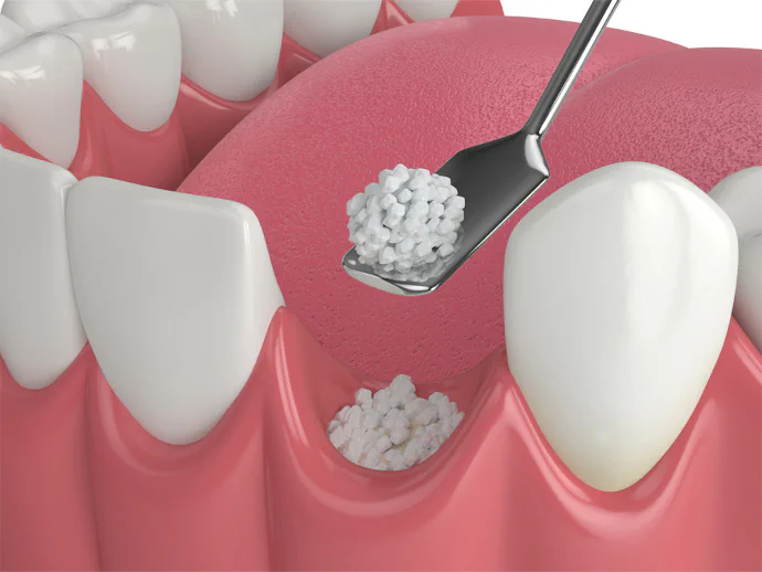 Dental bone grafting in Bowling Green, KY at Precision Dental.