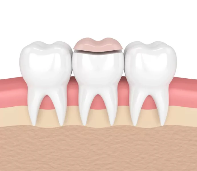 Dental inlays and dental onlays in Bowling Green, KY at Precision Dental.
