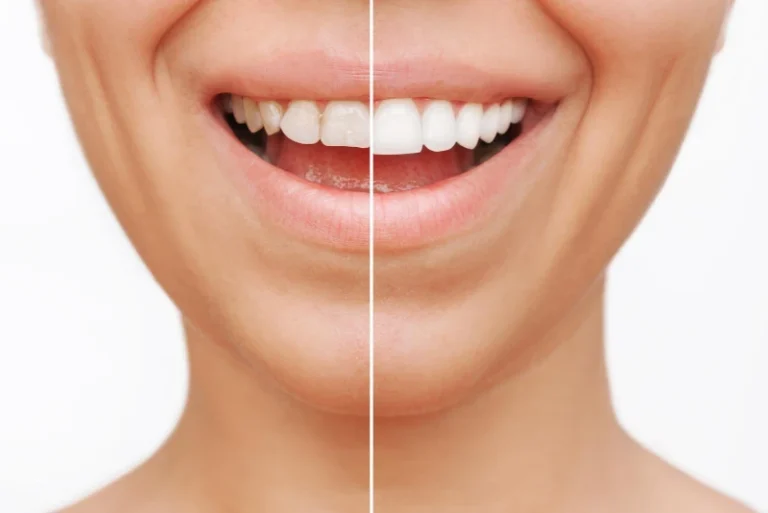 How Dental Veneers Can Transform Your Smile at Precision Dental in Bowling Green, KY.